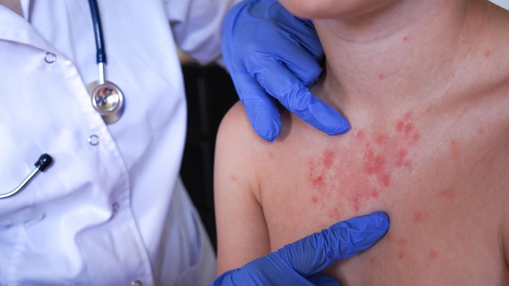 Minnesota's 80 measles cases this year are the most since 1990, health officials say — Minnetonka Health news